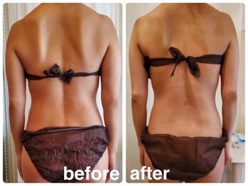 エステサロン キュート(Cute)/Wマシン×ハイパーナイフ上半身