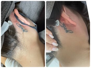 ビューティーホームサロン(Beauty Home Salon)/襟足脱毛