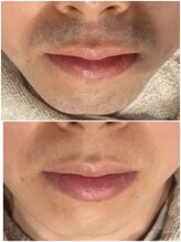 グロー(GLOW)/メンズヒゲ脱毛