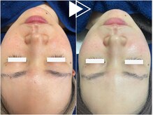 リシェス(Richesse)/毛穴赤み改善★初回¥9990