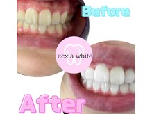 エクシアホワイトニング 沖縄宮里店/お客様ビフォア