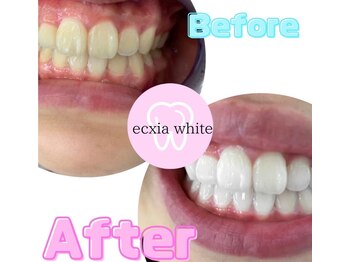 エクシアホワイトニング 沖縄宮里店/お客様ビフォア