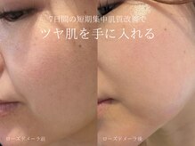 ラシュール(Rassure)/ローズドメーラ before/after