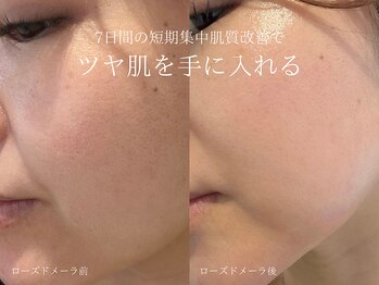 ラシュール(Rassure)/ローズドメーラ before/after