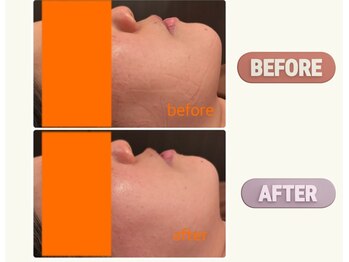 リフェムラボ(リフェムLABO)/小顔&ハイドラ毛穴洗浄