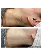 エアリアル 大牟田店/自分では剃れない所は脱毛を♪