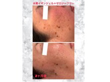 アンリール(ANRIRE)の雰囲気（水素イオンジェルとゼロジーフリーでお肌のキメUP・シミケア◎）