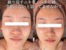 【大人ニキビ・肌荒れ】ハーブピーリング＋幹細胞美容液導入でトラブル肌改善