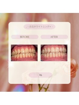 プラスビーセルフ(+b self)/ホワイトニングビフォーアフター