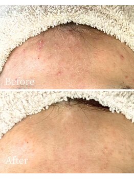 ニキビケア 毛穴研究所 立川店/おでこニキビでお悩みの方へ