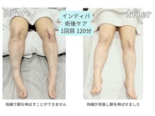 カリド ラボ(CALIDO LAB)/インディバ　術後ケア1回120分