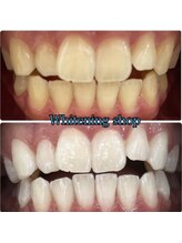 ホワイトニングショップ 南堀江店/セルフホワイトニング[南堀江]