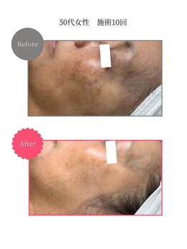 ボータン 恵(Beau Temps)/ウルトラ光トーニング/シミ改善