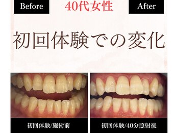 ホワイトニングセンター 長野駅前店/【長野市ホワイトニング】