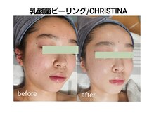 セレブリティ(Celebrity)の雰囲気（乳酸菌ピーリング紫外線や乾燥などで敏感になったお肌を優しく）