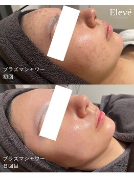 エルヴェ(Eleve)/プラズマシャワー/初回&8回目