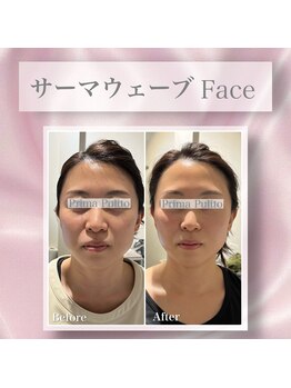 プリマプリート 可児店の写真/1秒リフトで小顔を実感！韓国発インコアシェイプ《サーマウェーブ》マイクロ波で理想のフェイスラインへ♪