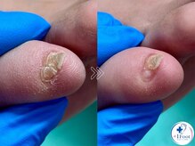 プラスワンフット 本厚木(+1 Foot)/痛い・引っかかる・邪魔な副爪に