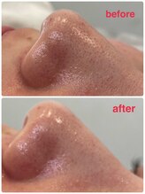 ルプリュシュ ルフレ(Le plus reflet)/毛穴洗浄ハイドロ♪