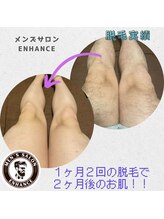 エンハンス 亀有(enhance)/脱毛実績