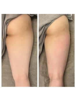 美温(mion)/ヒップアップ＆太ももケア