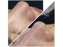 ジュエカフネ 広尾(JueCAFUNe)/毛穴汚れごっそり吸引！