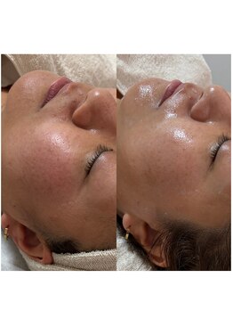 サロン ラン(salon rann)/赤み/face &nbsp;wax &nbsp;× &nbsp;UNSTRESS