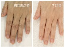 キレイテ 福岡天神店/血色の悪さ、ハリのなさ