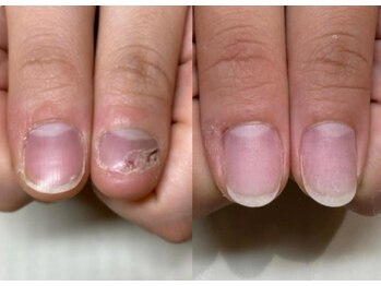 キュアネイル(Qa Nail)/繰り返す深爪にも対応！！