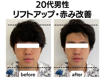 シン(SHINE)/美容鍼灸