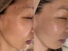 シュリー(Sriii)/インディバ×エンビロン集中ケア