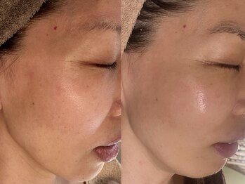 シュリー(Sriii)/インディバ×エンビロン集中ケア