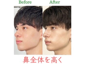 ラプリ 福岡天神店(Raplit)/隆鼻+輪郭・小顔矯正 美鼻/小顔