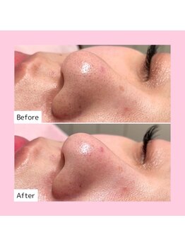 ホワイトラボ 新潟万代(White labo)/【施術例】ハイドロフェイシャル