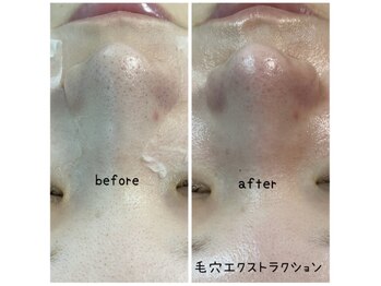 プルナモ(Purnama)/毛穴エクストラクション