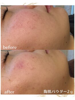 ヒーリングハーツ(Healing Hearts)/初めてのエステで肌質改善!