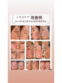 雅菜(miyabina)/肌荒れ改善例