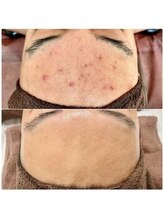 ラエッセ 目黒 白金台店(LAESSE)/毛穴・美白専門店 LAESSE 白金台