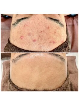 ラエッセ 目黒 白金台店(LAESSE)/毛穴・美白専門店 LAESSE 白金台