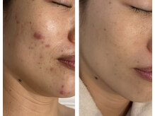 アドビューティ(Add Beauty)/≪プラズマフェイシャル≫