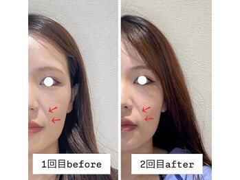 ウル(ulu)/電気を流す美容鍼２回☆