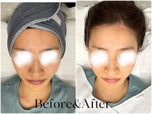 トウキョウビューティーラボ(TOKYO BEAUTY LABO.)/スノーピールBefore&After