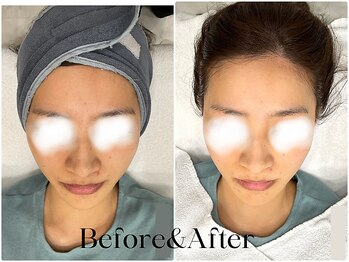 トウキョウビューティーラボ(TOKYO BEAUTY LABO.)/スノーピールBefore&After