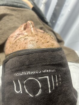 ミュラ(Myura)の写真/毛穴洗浄で角栓すっきり洗浄し毛穴の黒ずみへアプローチ！iLLONハーブピーリングで美しいお肌へ☆