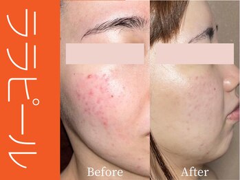 ビューティーリバース 大船店/ララピール50分