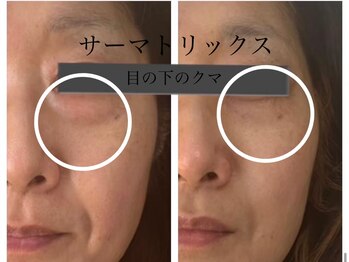 アモール(AMOR)/サーマトリックス[たるみケア]