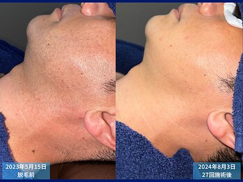 父さん専用ヒゲ脱毛の店/脱毛比較　＃メンズ脱毛＃脱毛