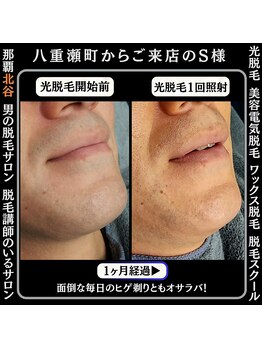 メンズディースタイル 首里店(Men's Dstyle)/那覇メンズ脱毛Before After