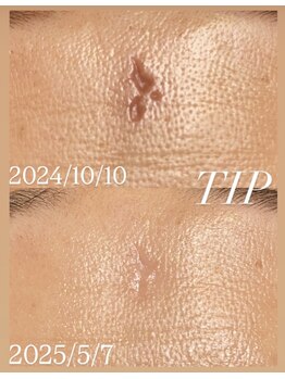 ムーンリズム(Moonlism)/【TIPハーブ症例】跡