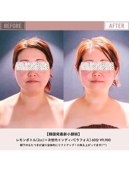 マーリエ(Malie)/【ラフォス×レモンボトル】小顔